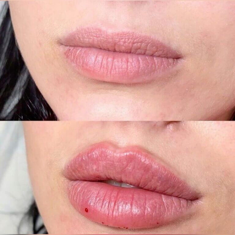 Lipfiller