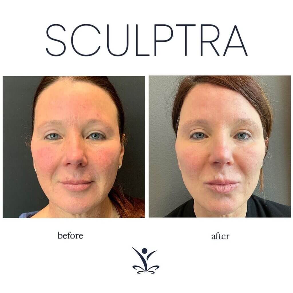AestheFill of Sculptra