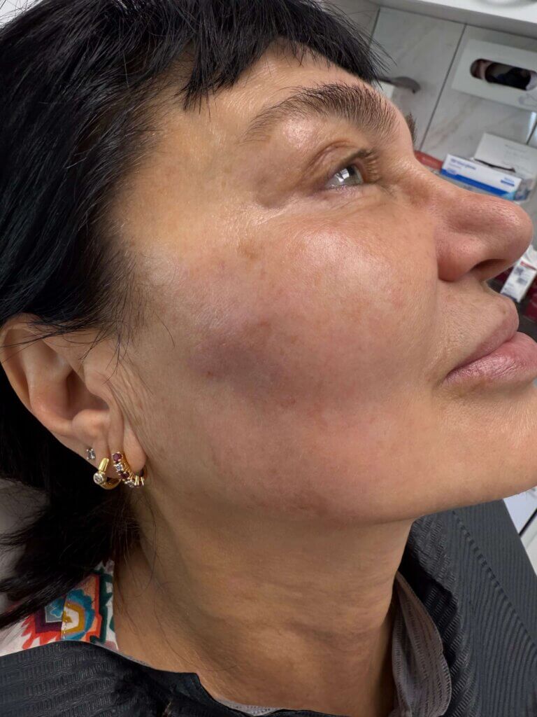 Sculptra – Natuurlijke verjonging