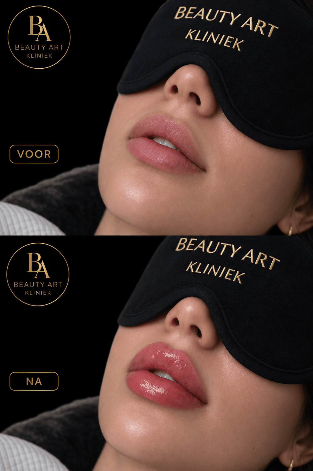 Voor en na fillers